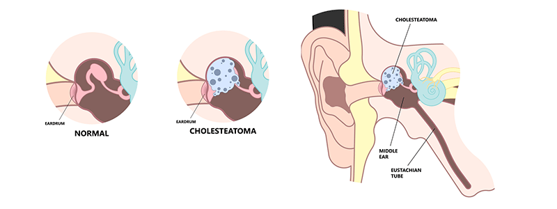 Pediatric Cholesteatoma - Children's Health