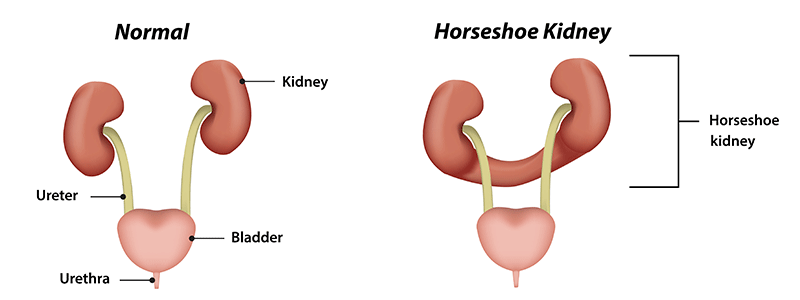 Horseshoe Kidney - Children's Health