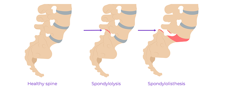 Spondylolisthesis amd Spondylolysis - Children's Health