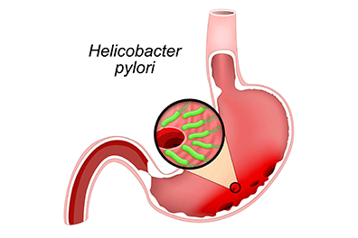 Helicobacter pylori (H-pylori) - Children's Health