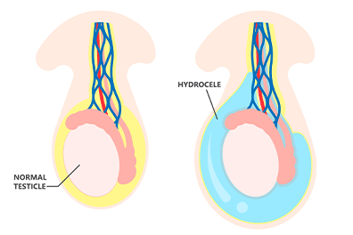 Hydrocele - Children's Health