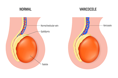 Pediatric varicocele in males - Children's Health