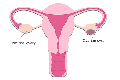 Ovarian Cyst - Children's Health