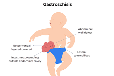 gastroschisis in infant - Children's Health