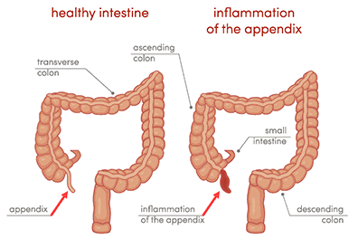 Appendicitis illistration - Children's Health