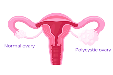 Polycystic ovarian syndrome (PCOS) - Children's Health
