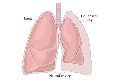 Collasped lung or pheumothorax - Children's Health