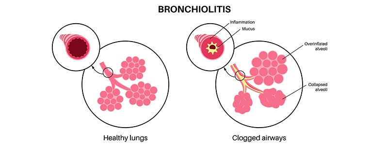 Pediatric bronchiolitis - Children's Health