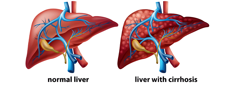 Pediatric cirrhosis of the liver - Children's Health