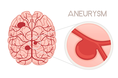 Pediatric brain aneurysm -  Children's Health