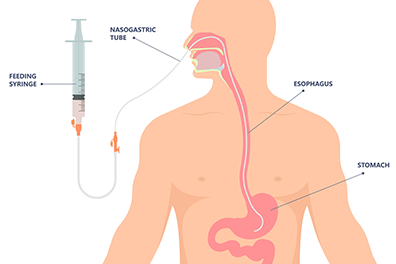 Pediatric enteral and parenteral nutrition