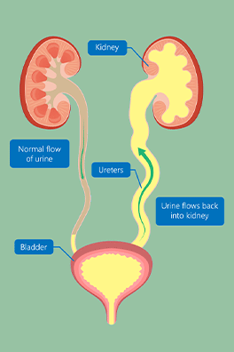 Pediatric vesicoureteral reflux (VUR) - Children's Health