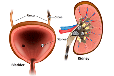 Nephrolithiasis Kidney Stones - Children's Health