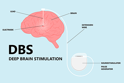 Pediatric deep brain stimulation (DBS) - Children's Health