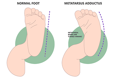 Metatarsus adductus - Children's Health