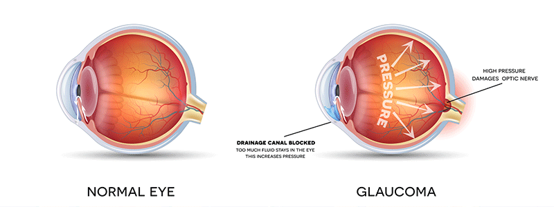 Pediatric glaucoma - Children's Health