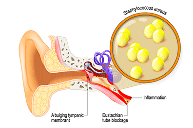 Ear infections - Children's Health