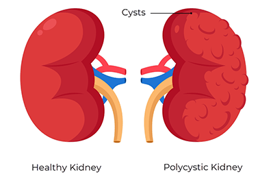 Polycystic kidney disease (PKD) - Children's Health