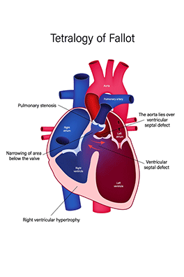 tetralogy of Fallot in newborns and infants - Children's Health