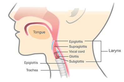 Pediatric laryngeal stenosis - Children's Health