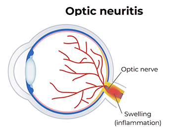 pediatric optic neuritis (ON) - Children's Health