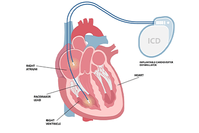 Pediatric implantable cardioverter defibrillator (ICD) - Children's Health