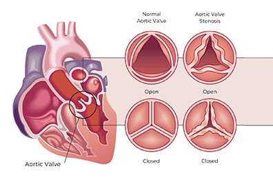 Pediatric aortic stenosis - Children's Health