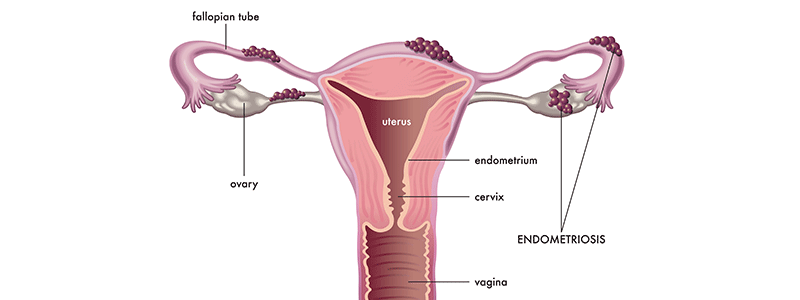 Endometriosis - Children's Health