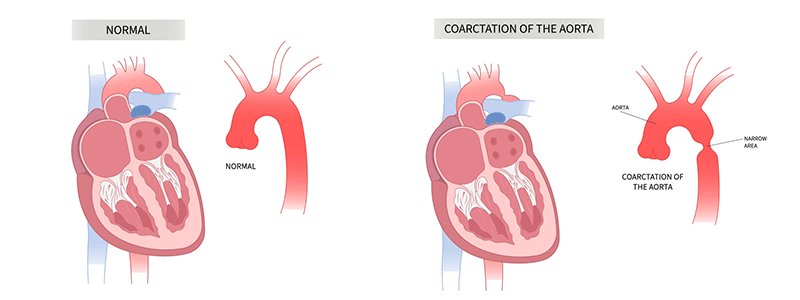 Coarctation of the aorta - Children's Health