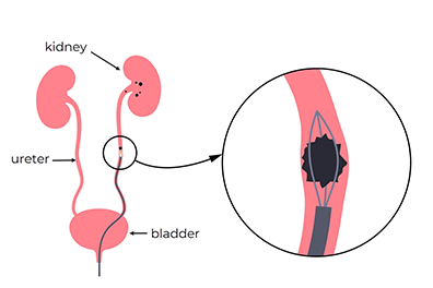 Pediatric ureteroscopy - Kidney Stones - Children's Health