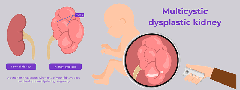 Multicystic dysplastic kidney in children (MCDK) - Children's Health