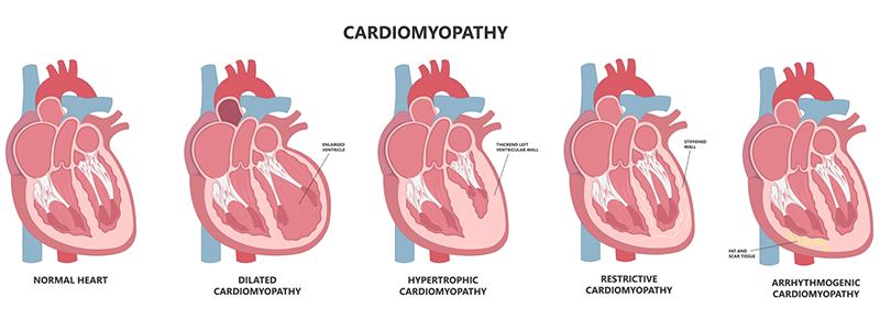 Cardiomyopathy in kids - Children's Health