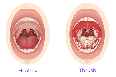 Pediatric thrush (oral candida infection) - Children's Health